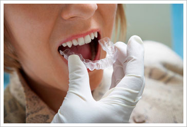 3D數碼隱形正畸